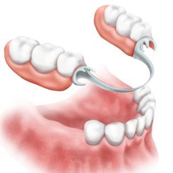 Clinica Dental Canet prostodoncia 6
