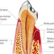 Clinica Dental Canet Periodoncia 3