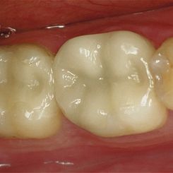 Clinica Dental Canet prostodoncia 3