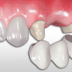Clinica Dental Canet prostodoncia 5