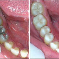 Clinica Dental Canet odontología conservadora 3
