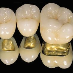 Clinica Dental Canet prostodoncia 2